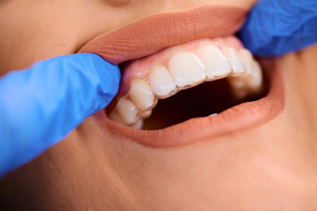 close up of woman getting dental aligner on her teeth